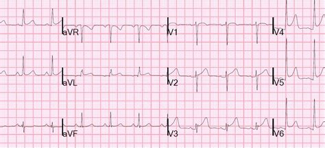 st elevation probably early repolarization